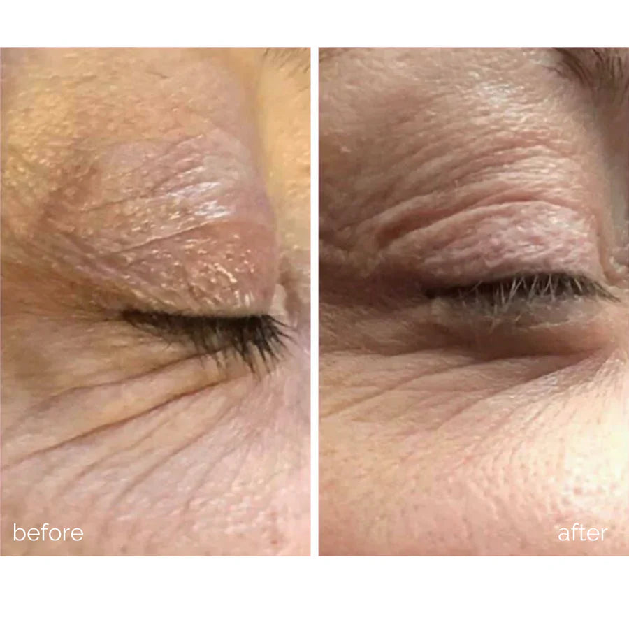 Before and after results of using MBK Eye Rejuvenator to reduce puffiness and eliminate dark under-eye circles.