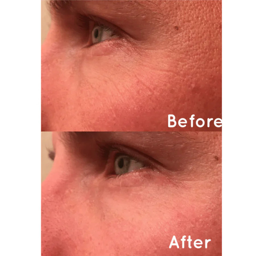 Before and after results using MBK Eye Rejuvenator, showing reduced puffiness and dark circles around the delicate eye area.