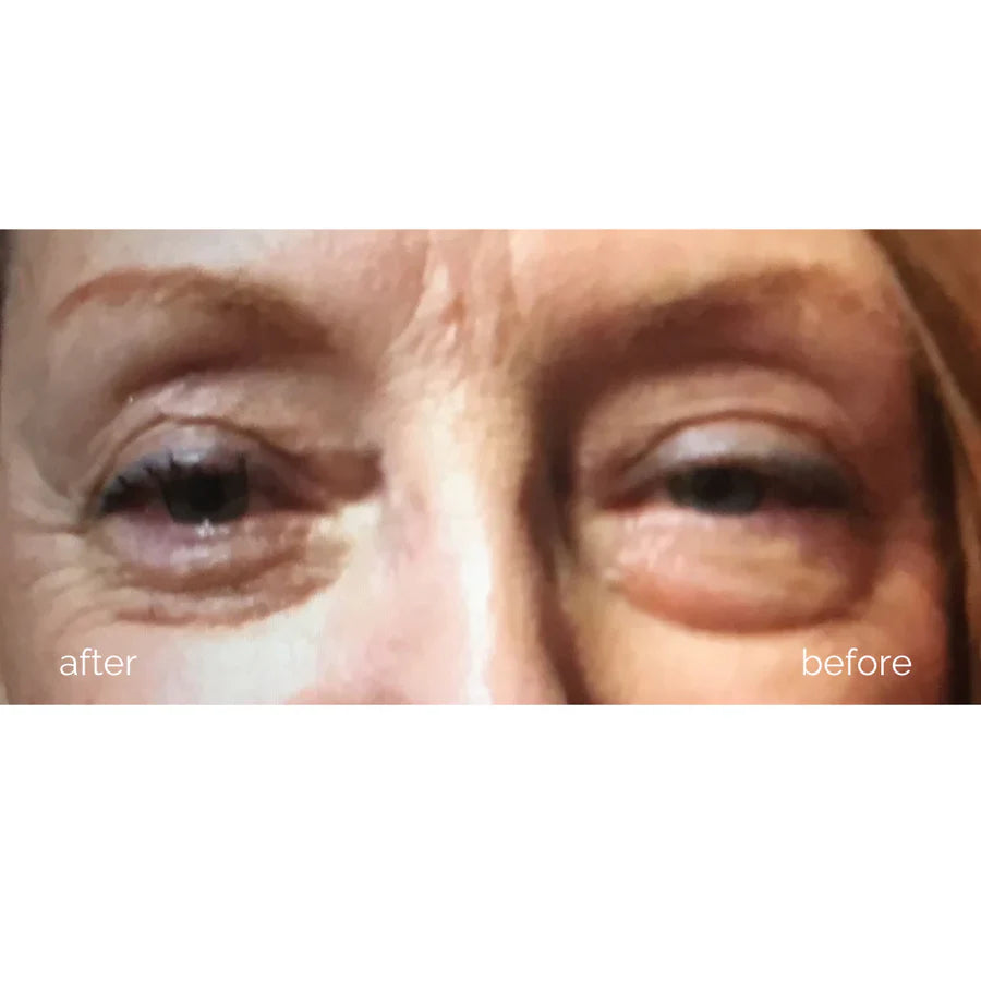 Before and after results showing reduced puffiness and dark circles under eyes with MBK Eye Rejuvenator microcurrent treatment.