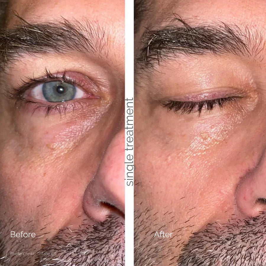 Before and after image showing reduced puffiness and dark circles under the eyes after using MBK Eye Rejuvenator microcurrent treatment.