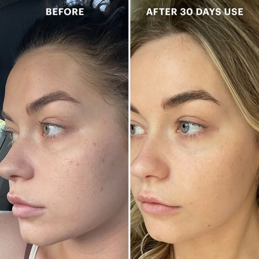 Before and after results using Beta-Clarity BHA Drops for 30 days showing improved skin clarity, reduced blemishes, and smoother complexion.