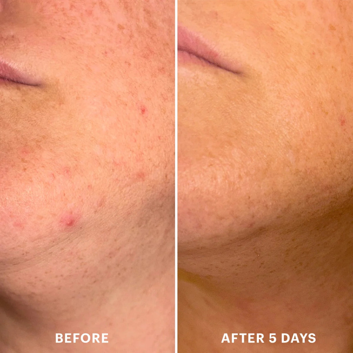 LED Spot Device | Glo Skin Beauty