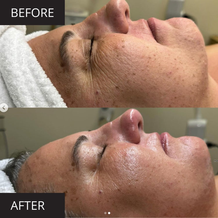 Before and after image showing the results of using the MyoLift™ Mini Home Care Kit for facial toning and wrinkle reduction