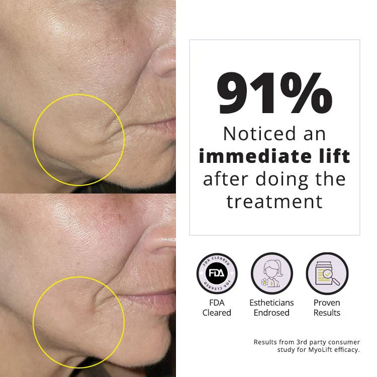 Before and after results from MyoLift™ QT Plus Facial Toning Device showing 91% noticed an immediate lift after treatment.